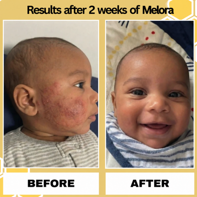Melora Bee Extract Eczema Essence