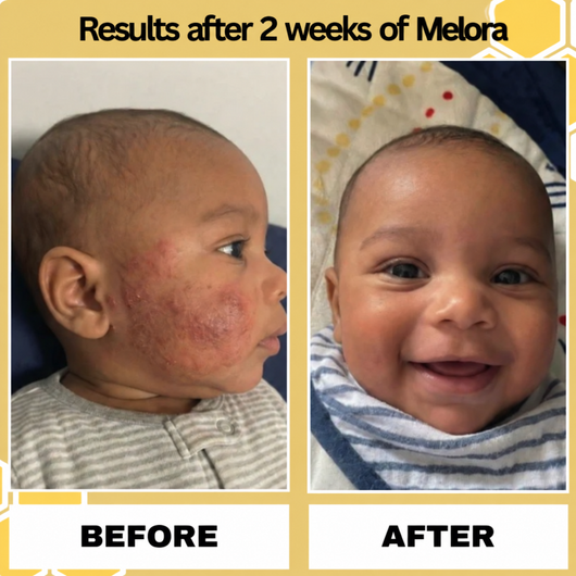 Melora Bee Extract Eczema Essence