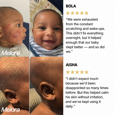 Melora Bee Extract Eczema Essence