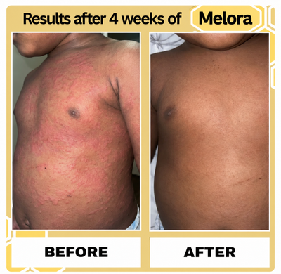 Melora Bee Extract Eczema Essence